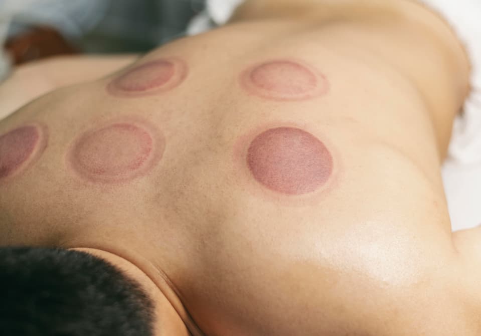 Medical Hijama cupping therapy at Royal Treat Clinic Dubai