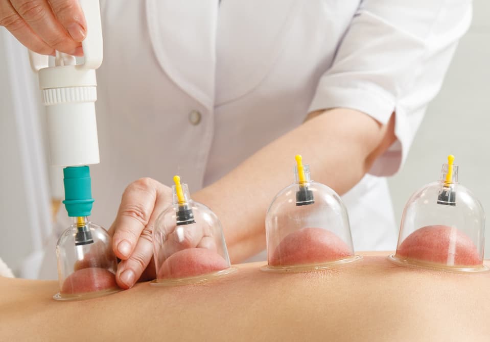 Prophylactic Hijama cupping therapy for PCOS hormonal balance at Royal Treat Clinic Dubai