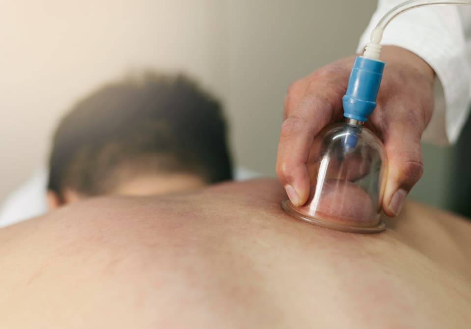 Ruqyah Hijama cupping therapy for natural fertility support at Royal Treat Clinic Dubai